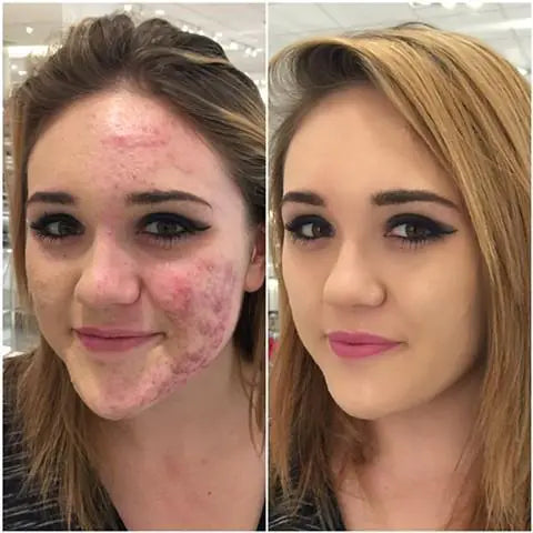 Beauty Cream Waterproof Foundation. Anti acne.